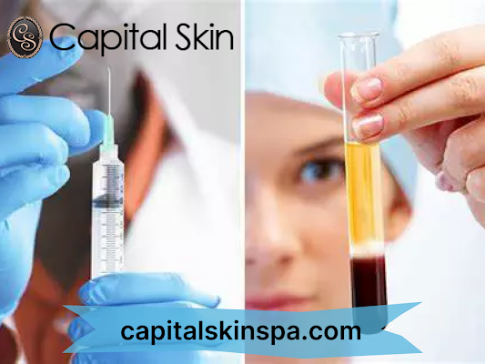 Capital Skin PRP Treatments