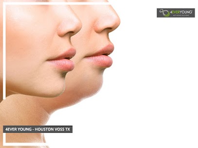 Double Chin Removal Houston Voss TX