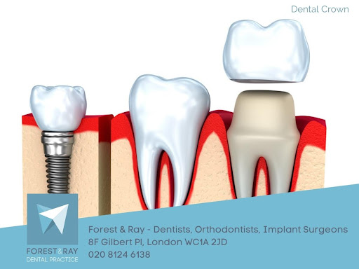 Tooth Crowns London