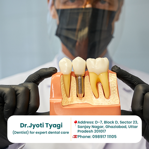 DENTAL IMPLANTS