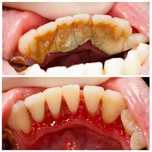 Professional dental cleaning