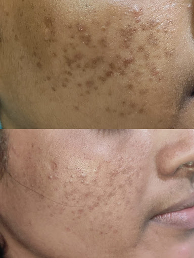 Acne Treatment