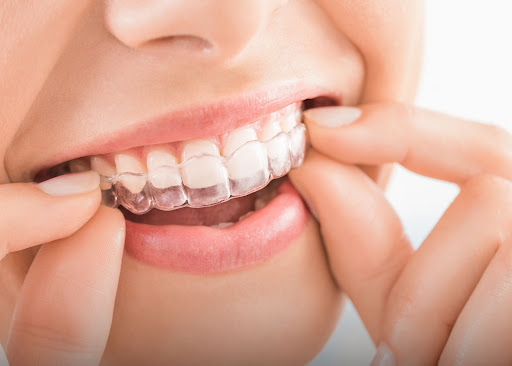 Invisalign Treatment in Noida Sector 20