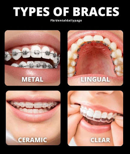 braces