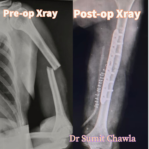 Humerus fracture fixation product image
