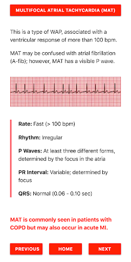 ECG FlashCards