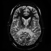 Adrenoleukodystrophy, and MRI showing T2 weighted axial scan at the level of the caudate heads demonstrates marked loss of posterior white matter, with reduced volume and increased signal intensity.