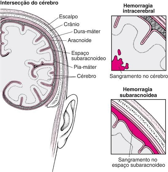 Estruturas do cérebro e os tipos de AVC hemorrágico.