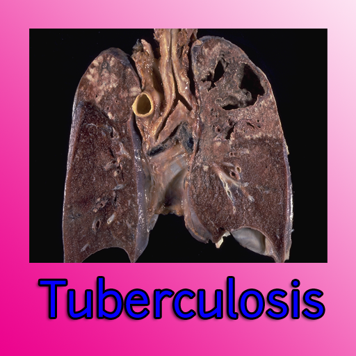 Tuberculosis