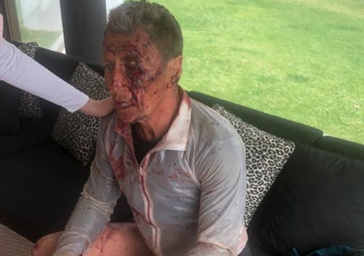 Nick Bester, bloodied and bruised after being attacked while training on Sunday. He has been moved from ICU to a high-care unit, his son Shaun-Nick said on Monday.