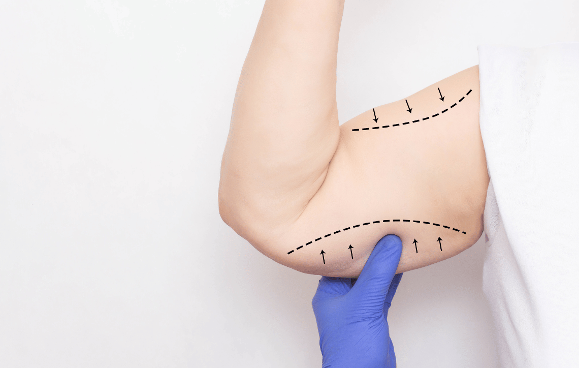 Liposuction on arm