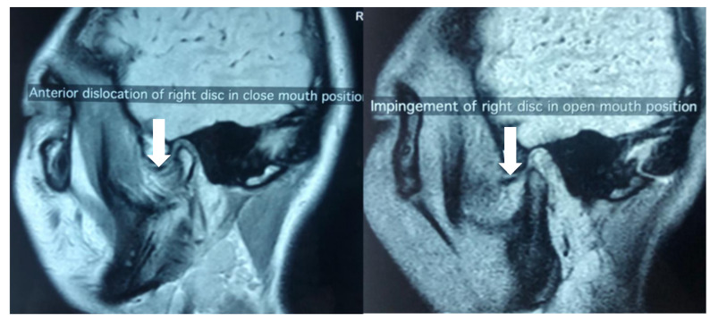 Resumo de disfunção temporomandibular: diagnóstico, tratamento e mais!