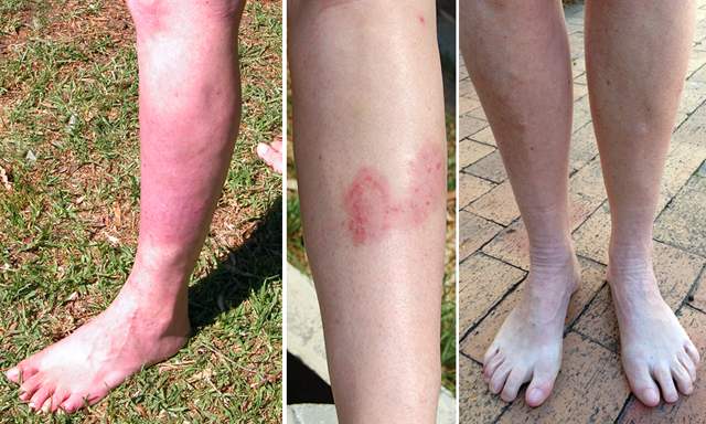 psoriasis before and after 2008-2010-2015