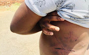 A foreign national shows wounds from where he was beaten up in Pretoria last week.