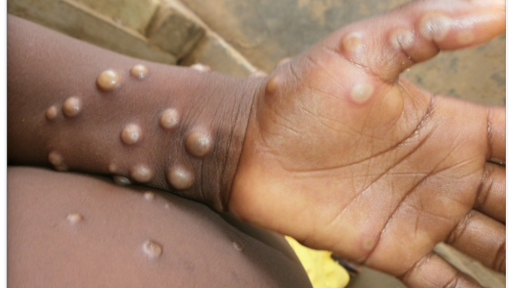 Belgium Starts MANDATORY Quarantine For Monkeypox
