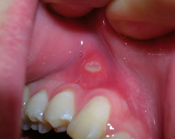 Gum Injuries | Children's Dentistry of Longwood, P.A.