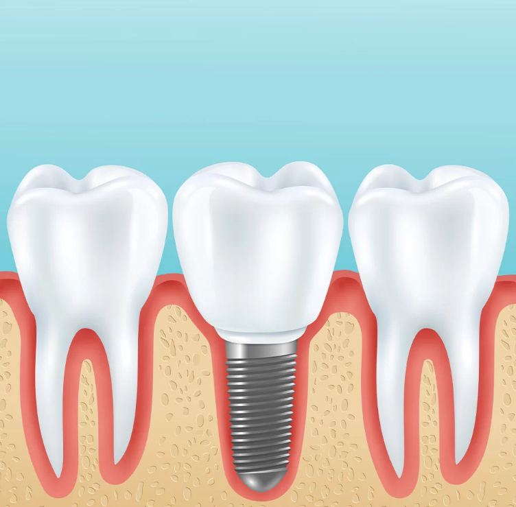 ایمپلنت دندان چیست و چه کاربردی دارد؟