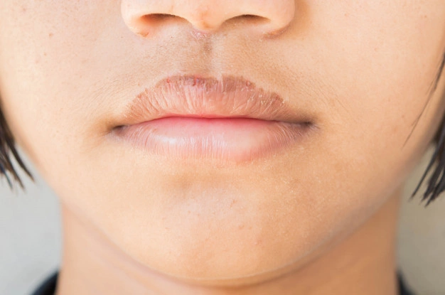 Chapped lips are more vulnerable to eczema on the lips.