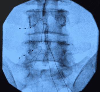 DRG Stimulation - Tualatin, OR & Newberg, OR: Spinal Diagnostics