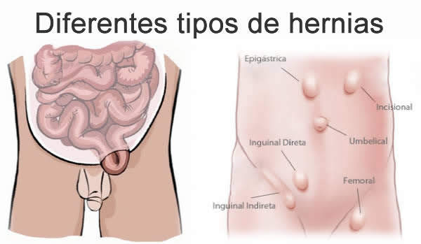 Hernias