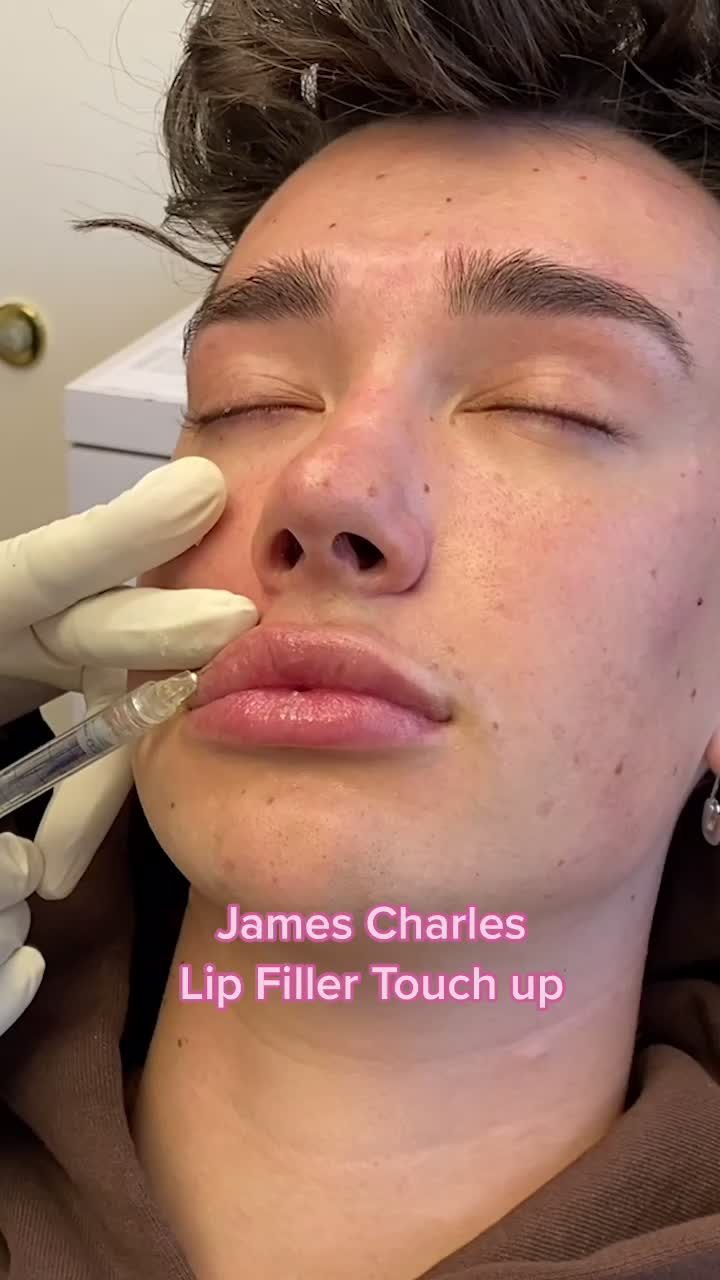 James Charles’s plastic surgery 