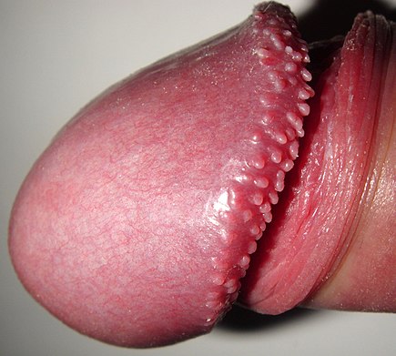 Close-up of penis head with pearly penile papules lining the glans' bottom