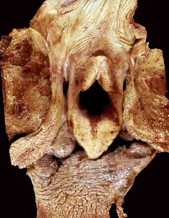 Multiple raised areas of pharyngeal nodular hyperplasia of tonsillar lymphoid tissues.