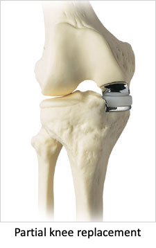 partial knee replacement surgery