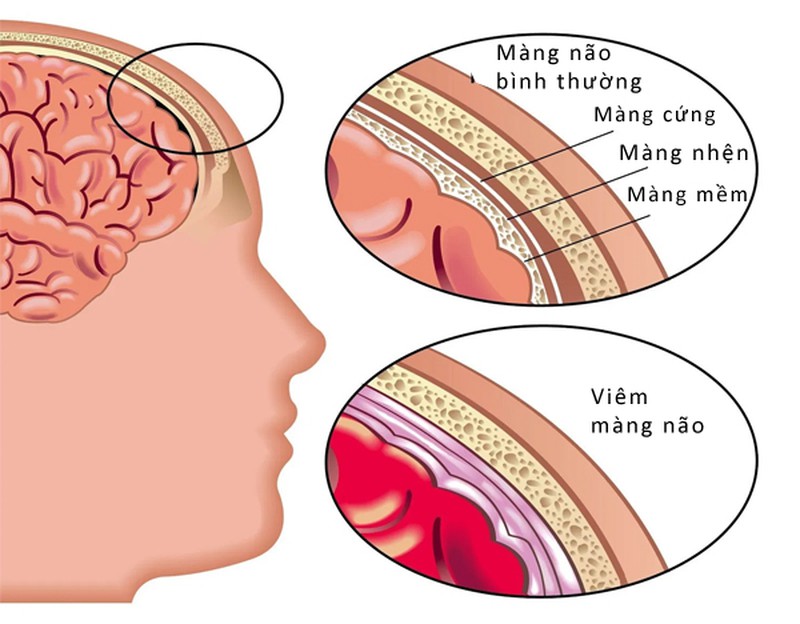 Viêm màng não là gì?