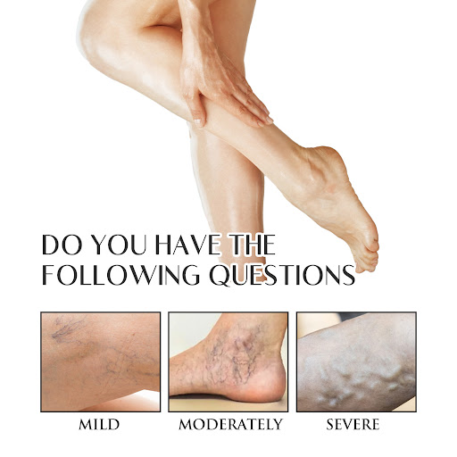 Title 2, Intravenous Spray for Leg Muscle Soreness Relie...