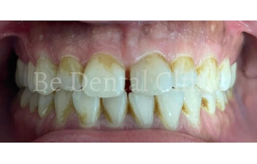 Dental Hygiene Be Dental Clinic Harley Street Dentist Marylebone London 