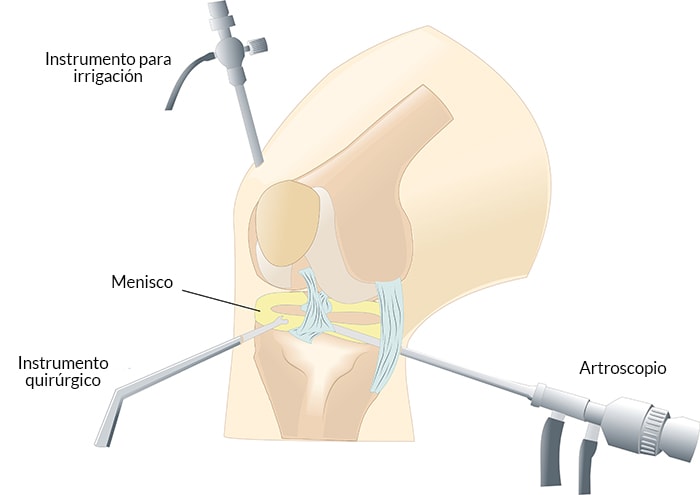 Artroscopia Rodilla Rotura Menisco Artrosasun Bilbao