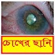 Download চোখের ছানি চিকিত্‍সা ~ Cataract Treatment For PC Windows and Mac 1.0