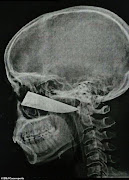 A scan shows the blade embedded in Shaun Wayne's head.