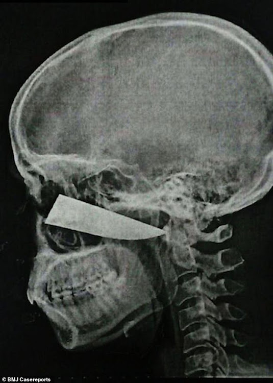 A scan shows the blade embedded in Shaun Wayne's head.