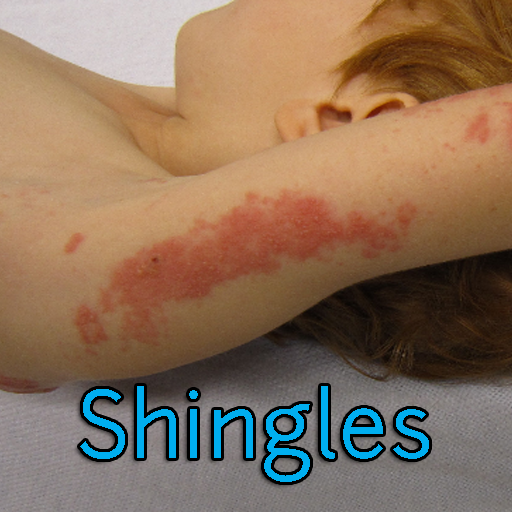 Shingles