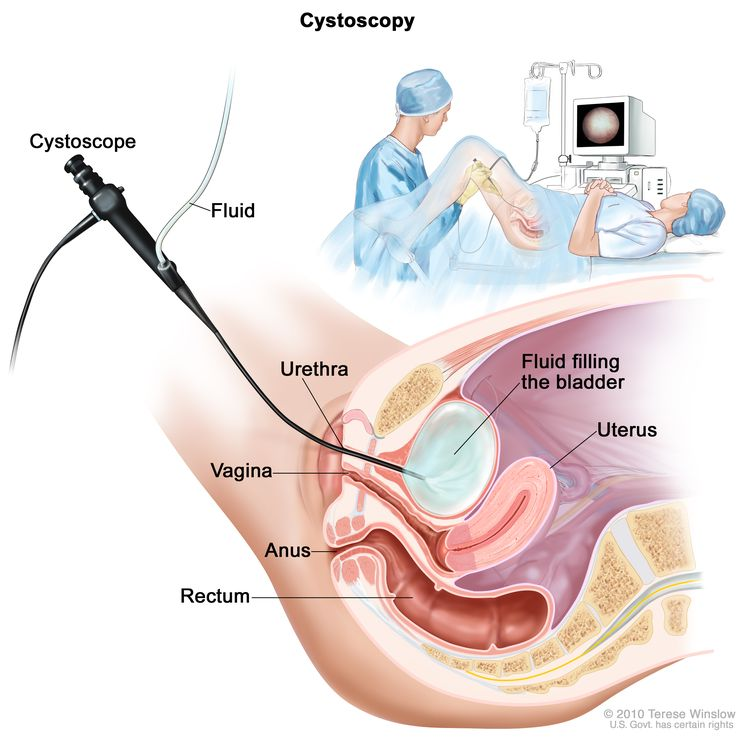 Cancro alla vescica