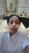 My face being numbed with a cream
