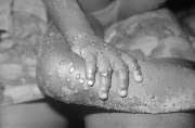 The first symptoms of the monkeypox virus usually appear after between five and 21 days. They include fever, headache, muscle aches, backache, swollen glands, shivering and exhaustion. The rash, sometimes confused with chickenpox, typically appears one to five days after experiencing these symptoms. File photo. 