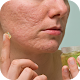 Download Acne Scar Removal Tips and Tricks For PC Windows and Mac 1.0