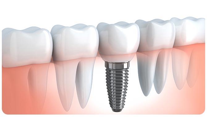 Temporary Solutions While Waiting For Your Dental Implant