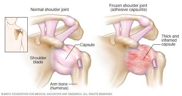 Illustration showing shoulder joint 
