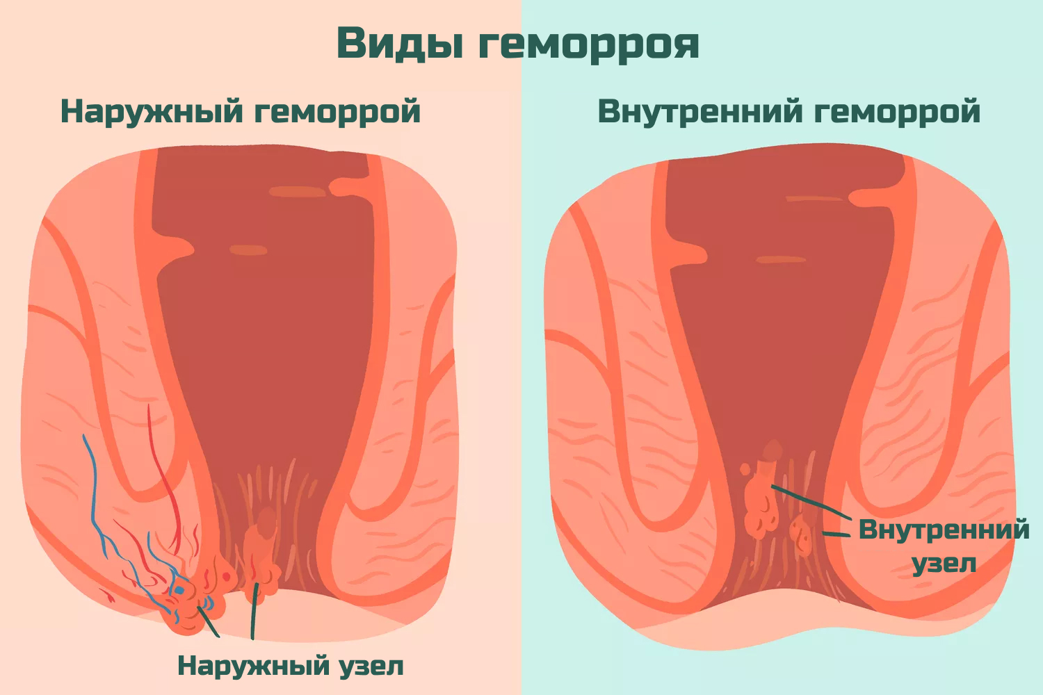 Внутренний и наружный геморрой - виды геморроя