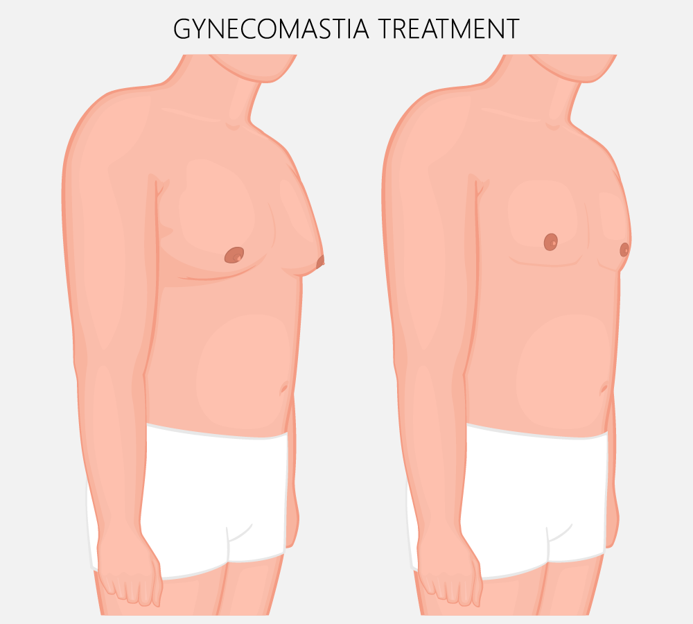 How to Handle Unwanted Male Breast Tissue (Gynecomastia)