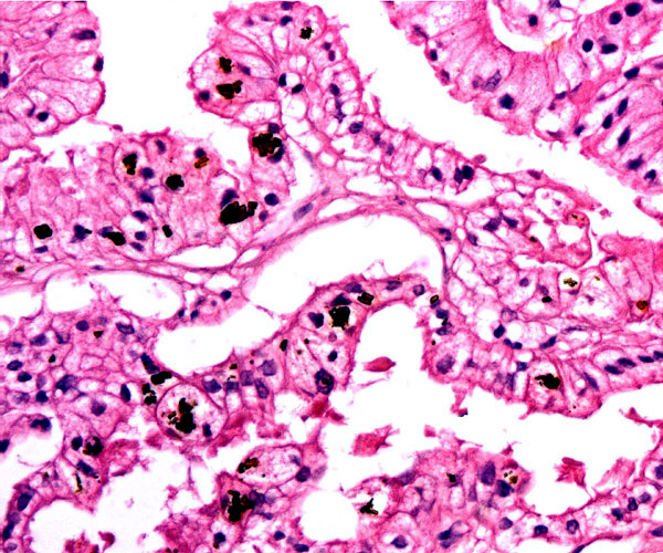 The columnar epithelium of the former haemophagous zone with pigment in the trophoblast. No maternal blood
