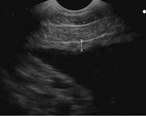 Imagen ecográfica transabdominal de la unidad útero-placentaria en una yegua con gestación normal de 320 días. La imagen fue obtenida con un transductor convexo de 7.5 MHz. La "X" marca el espesor de la unidad feto-placentaria.