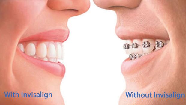 Invisalign in North York