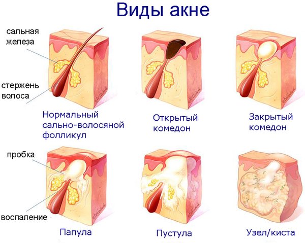 Акне (угри) - симптомы и лечение