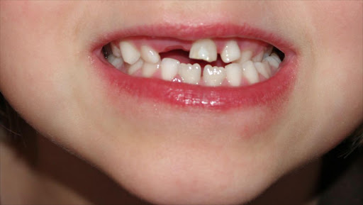 Deciduous teeth of a 6 year old girl. File picture.