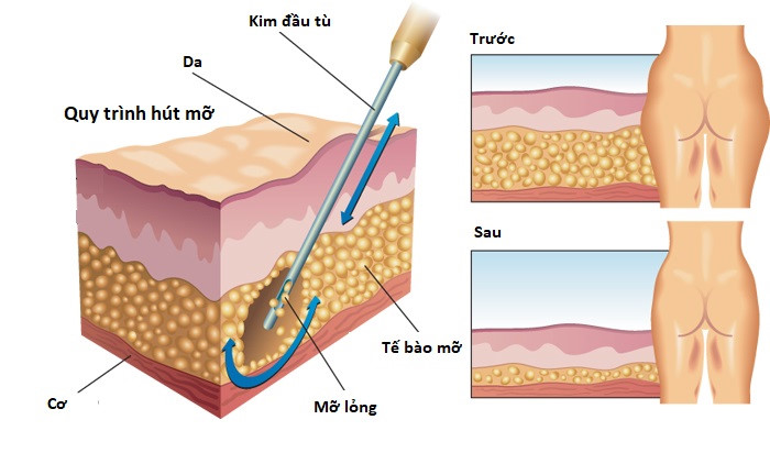 Để có thể tiến hành một ca phẫu thuật hút mỡ bụng an toàn, nhất thiết phải theo một quy trình rất nghiêm ngặt.